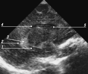 Эхограмма мозга - парасагиттальный срез через боковой желудочек