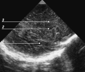 Эхограмма мозга - парасагиттальный срез через височную долю