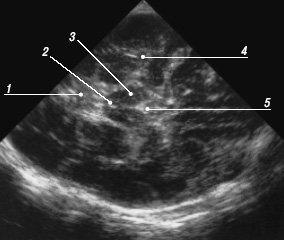 Эхограмма мозга - аксиальный срез на уровне основания мозга