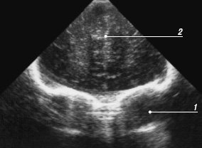 Эхограмма мозга новорожденного - первый корональный срез через лобные доли