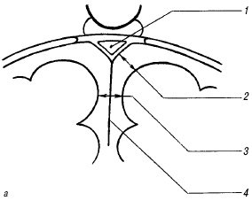 Схема: измерение ширины субарахноидального пространства и ширины межполушарной щели на одном-двух корональных срезах