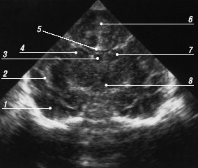 Эхограмма мозга - второй корональный срез через передние рога боковых желудочков