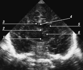 Эхограмма мозга - третий корональный срез через отверстия Монро