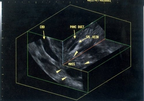 Эхограмма: панкреатический (PANC DUCT) и общий желчный (CBD) протоки