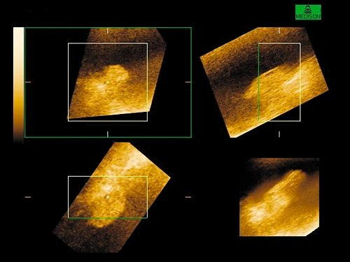 Получение 3D изображения на основании реконструкции серии эхотомографических срезов новообразования мочевого пузыря в различных проекциях