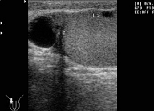 Узи придатка яичка. Сперматоцеле яичка УЗИ. Киста придатков яичка УЗИ. Киста придатка яичка на УЗИ. Киста семенного канатика на УЗИ.