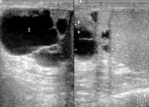 УЗИ: кисты придатка левого яичка