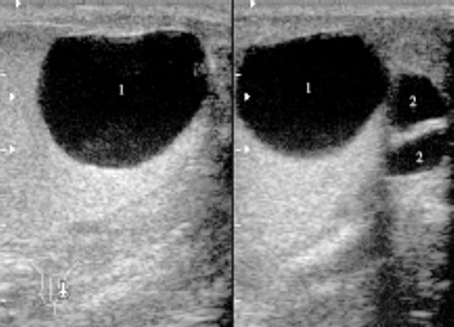 УЗИ: киста яичка и две кисты хвоста придатка