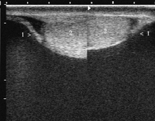 УЗИ: гигантское сперматоцеле у пациента (1 - капсула кисты, 2  - яичко)