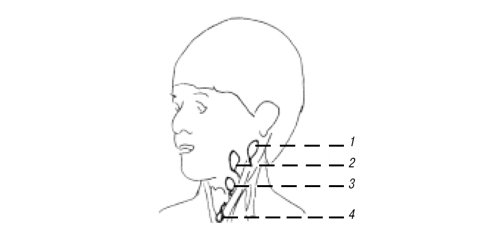 Схема: локализация кист (1-4) бранхиальной расщелины - данные Техасской ассоциации детских хирургов