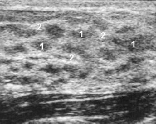 Эхограмма: молочная железа пациентки 16 лет (1 - перигландулярная строма,  2 - опорная строма)