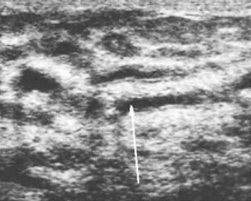 Эхограмма: молочная железа пациентки 24 лет на 10-е сутки после родов при гипогалактии (стрелками обозначены расширенные протоки в центральном участке железы, окруженные перигландулярной стромой