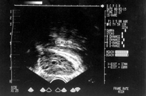 Эхографическая картина яичника при центральной форме cиндрома гиперандрогении (а)