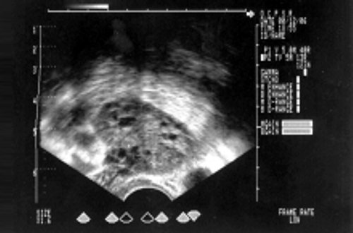 Эхографическая картина яичника при центральной форме cиндрома гиперандрогении (б)