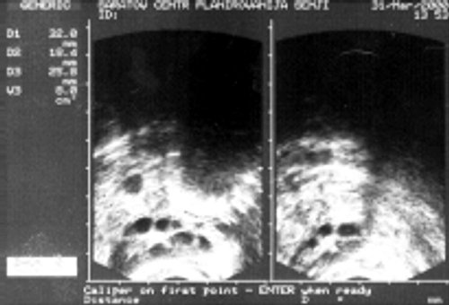 Эхографическая картина яичника при надпочечниковой гиперандрогении