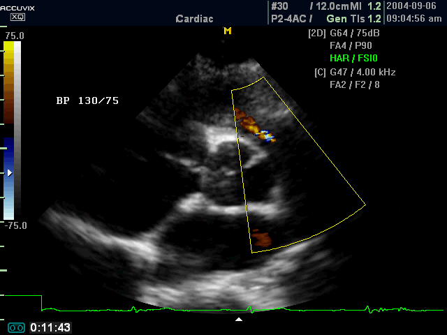Pulmanic artery, color doppler (echogramm №367)