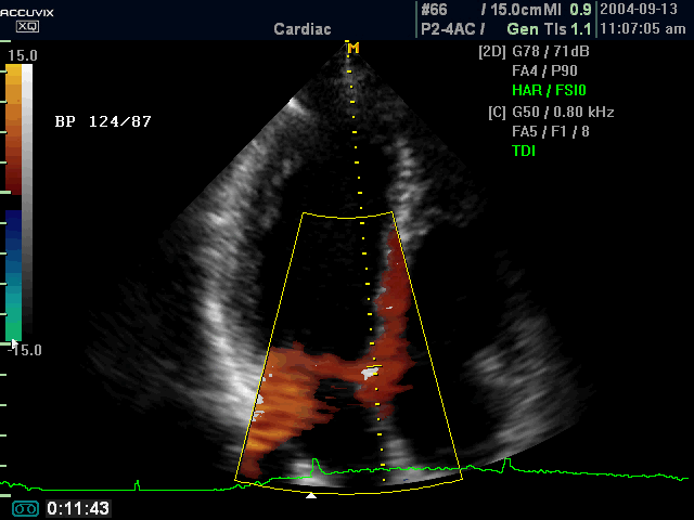 Heart, tissue doppler (echogramm №368)