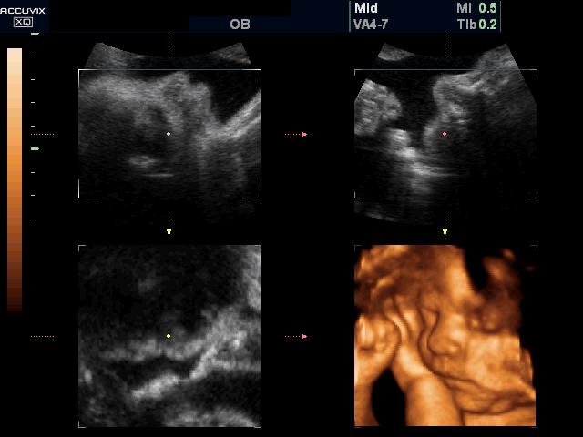 Fetal face, 3D (echogramm №386)