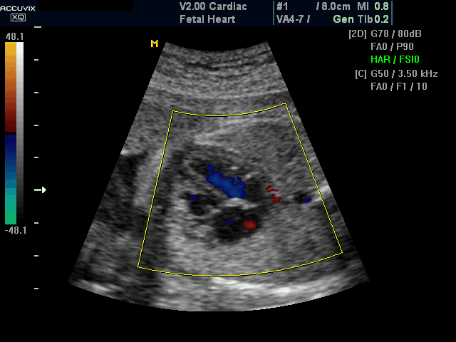 Ultrasound images • Fetal heart, color doppler, echogramm №388
