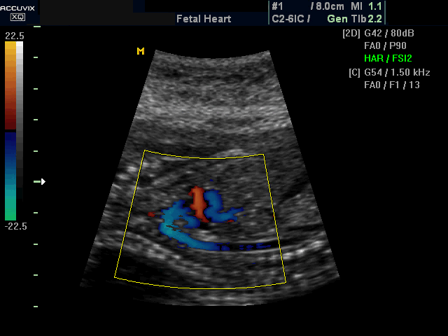 Fetal heart - aortic arch, color doppler (echogramm №389)