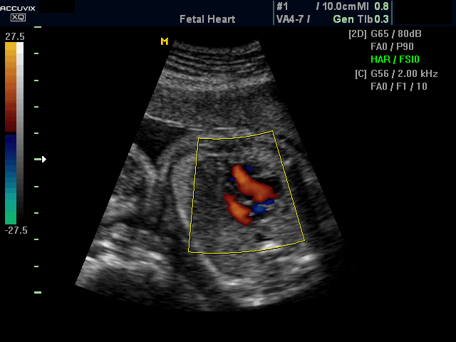 Fetal heart - LVOT, color doppler (echogramm №392)