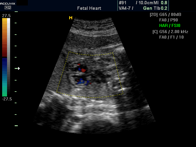 Fetal heart - RVOT, color doppler (echogramm №393)