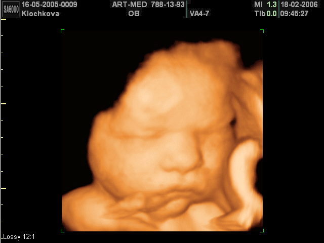 Fetal face and photo of baby, 3D (echogramm №397)