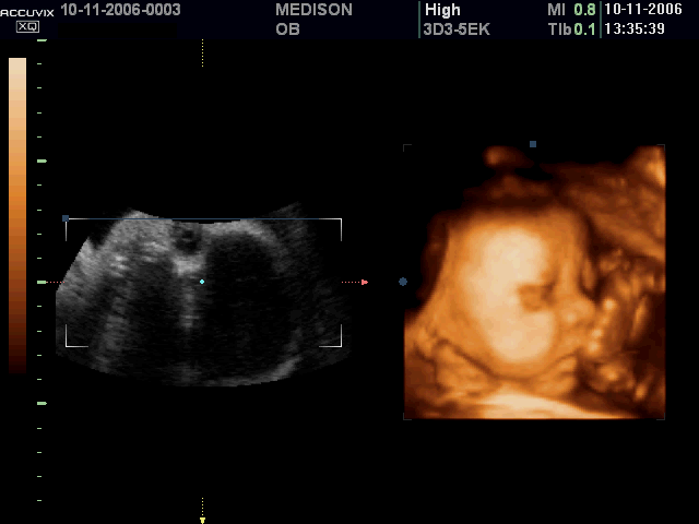 Fetal face and umbilical cord, 3D (echogramm №430)