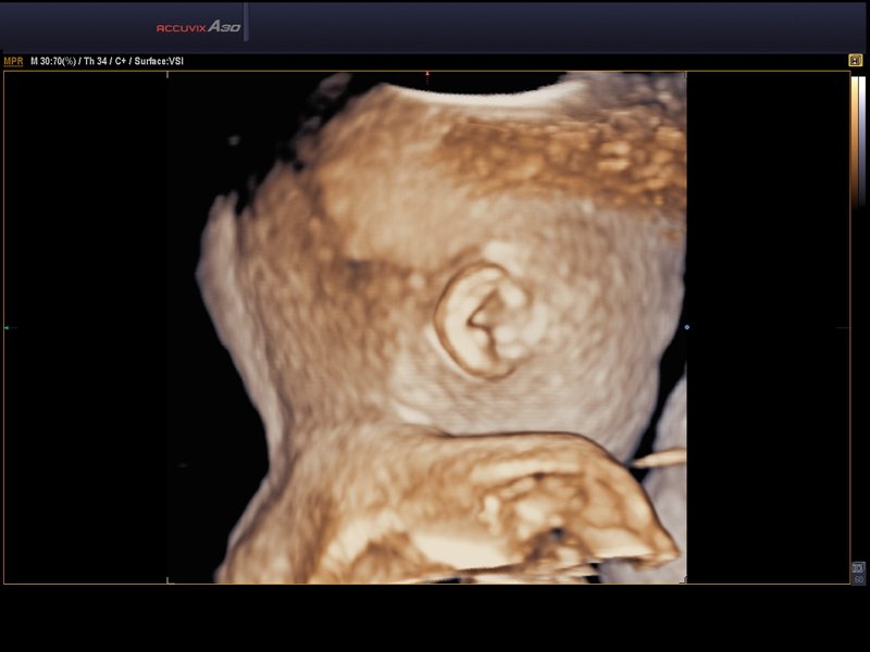 Fetal head, VSI & 3D (echogramm №563)