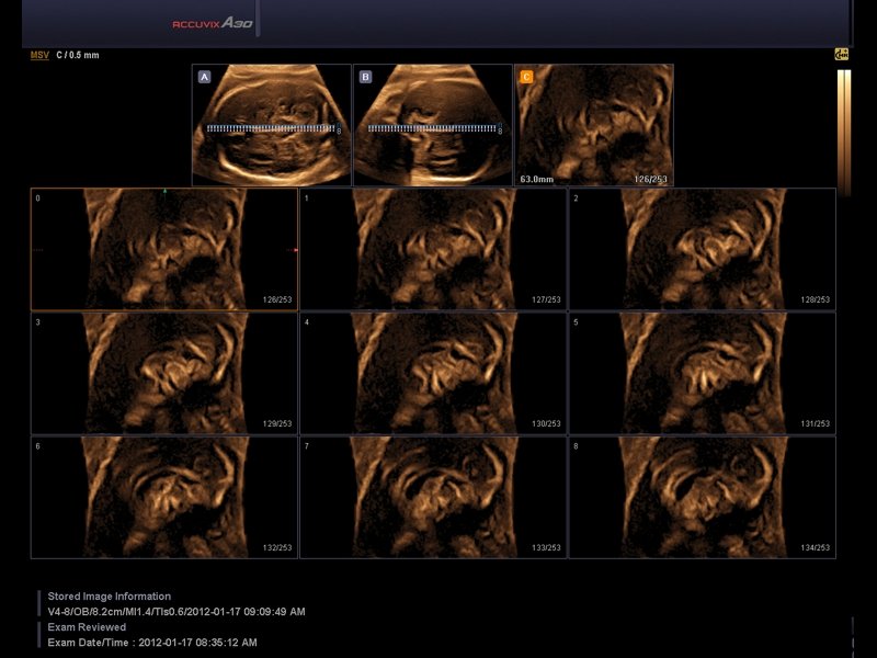 Corpus callosum of fetal brain, MSV+ОН и 3D (echogramm №564)