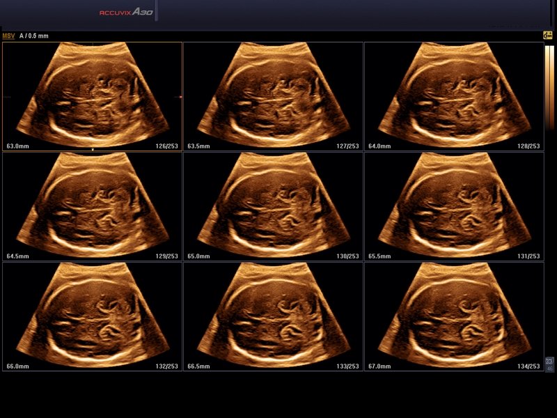 Fetal brain, MSV & 3D (echogramm №565)