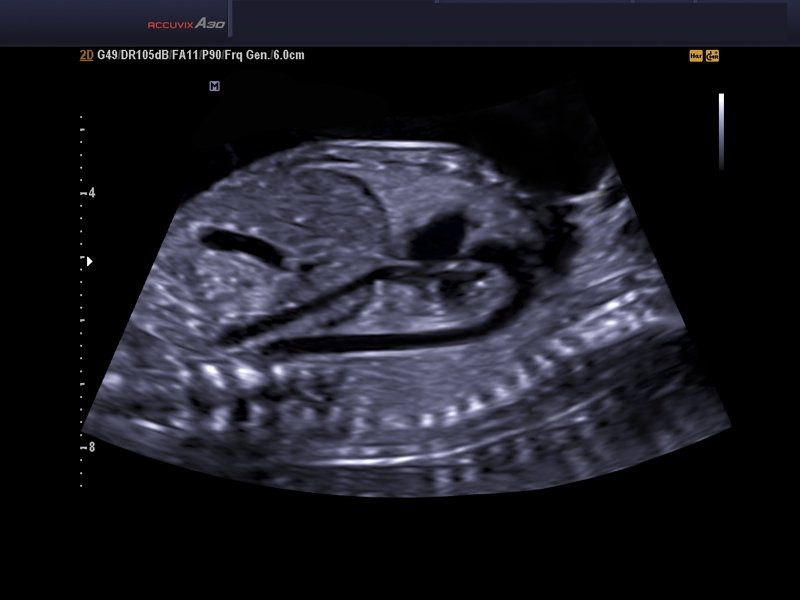 Fetal heart aortic arch, THI & DMR (echogramm №567)