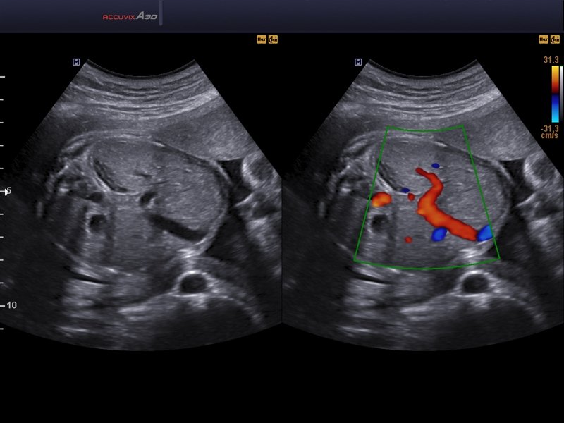 Fetus, abdomen, B-mode & CFM (echogramm №568)
