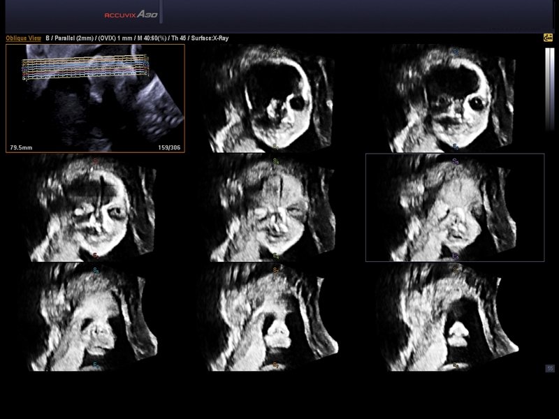 Fetal face, Multi OVIX & 3D (echogramm №569)