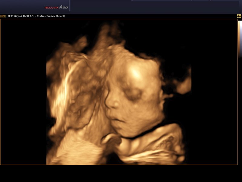 Fetal face, 3D (echogramm №570)