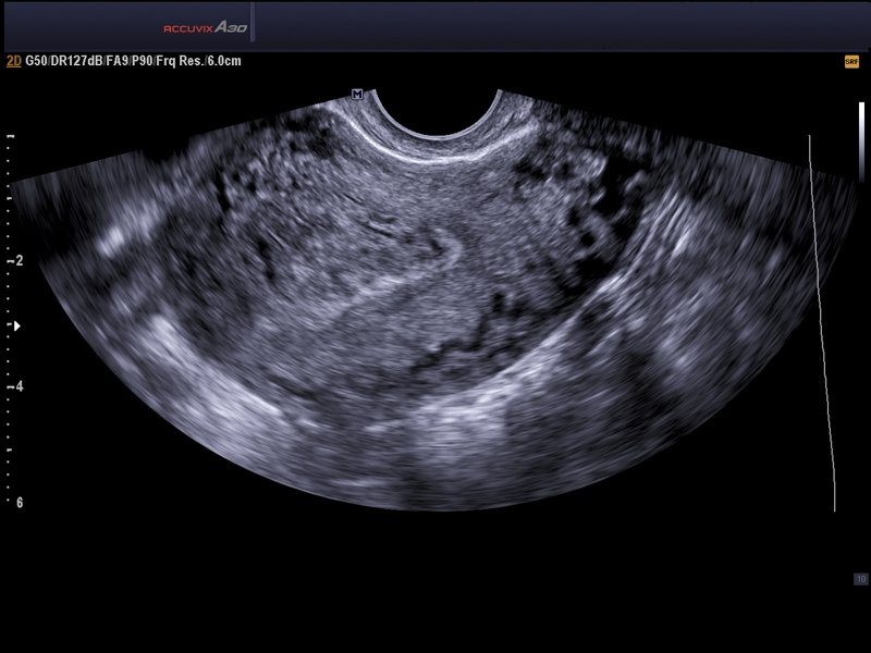 Uterus adenomyosis, B-mode & SRF (echogramm №571)