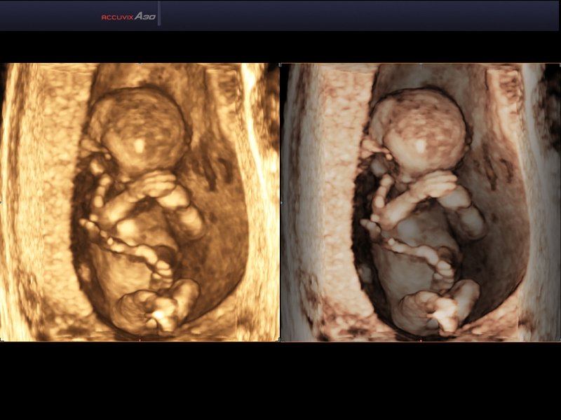 Embryo, Surface & VSI, 3D (echogramm №572)