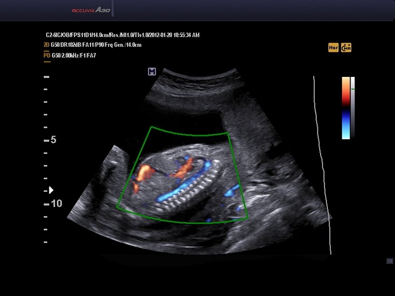 Fetus, Color OptFlow, THI & DMR (echogramm №573)