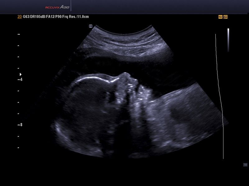 Fetal face, THI & DMR (echogramm №574)