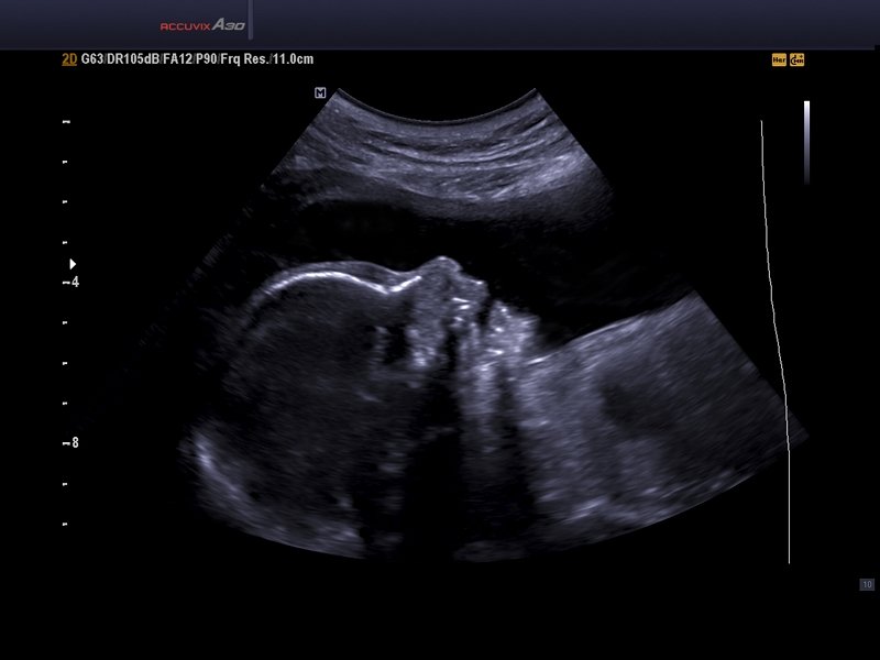 Fetal face, THI & DMR (echogramm №574)