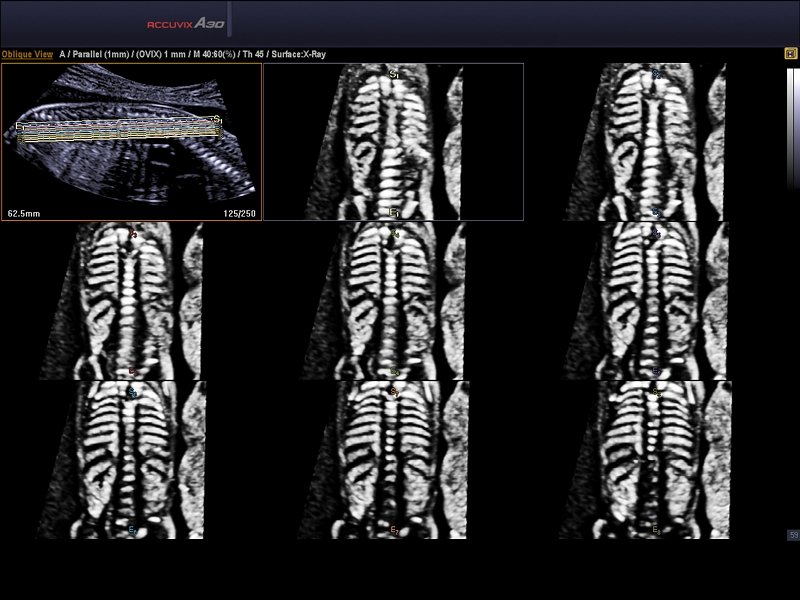 Fetal spine, Multi OVIX & 3D (echogramm №575)