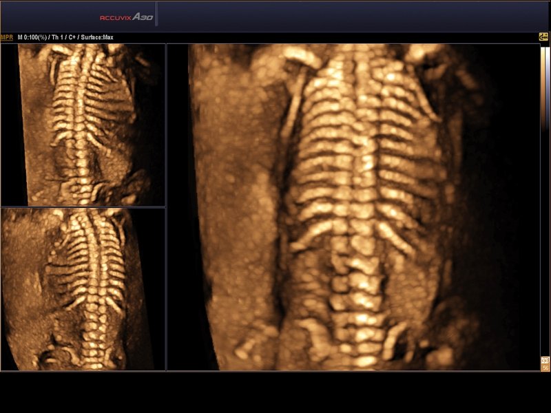 Fetal spine, 3D (echogramm №576)