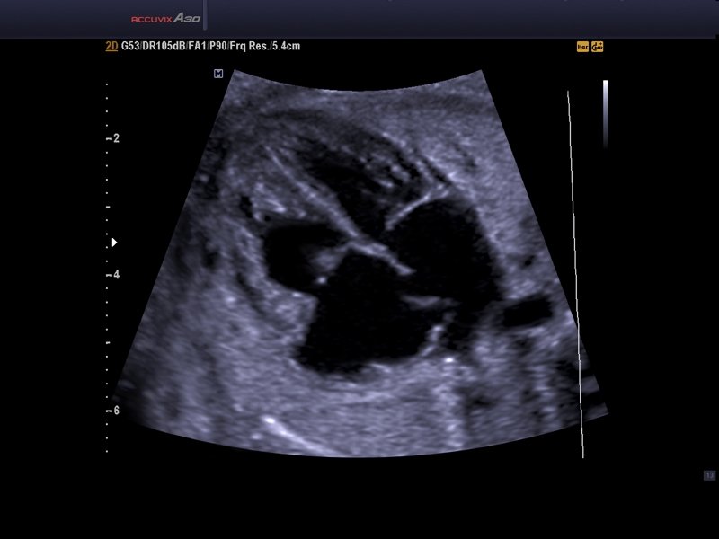 Fetal heart (4 chamber view), B-mode (echogramm №577)