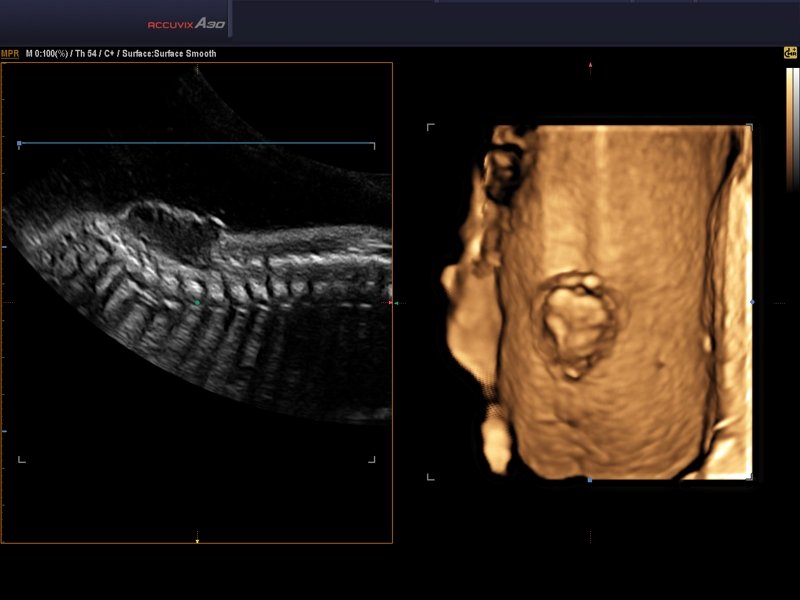 Spina bifida - defect of fetal`s development, 3D (echogramm №578)