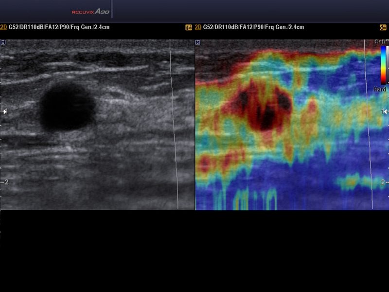 Breast, elastography (echogramm №579)