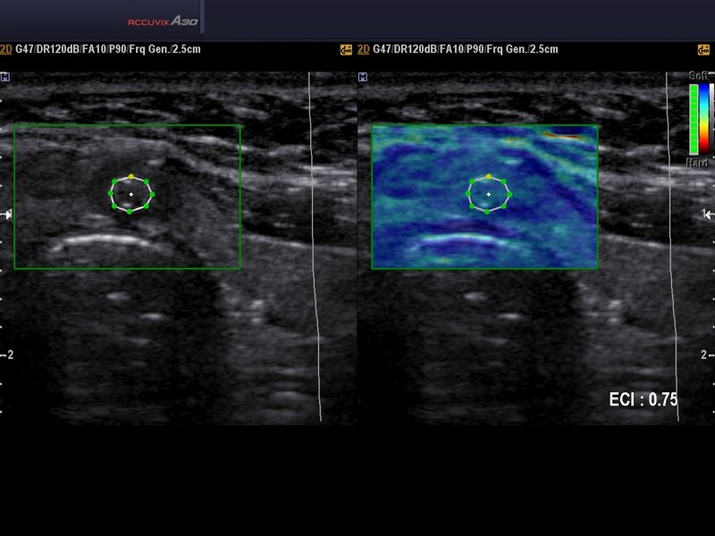 Thyroid isthmus adenoma, elastography (echogramm №580)