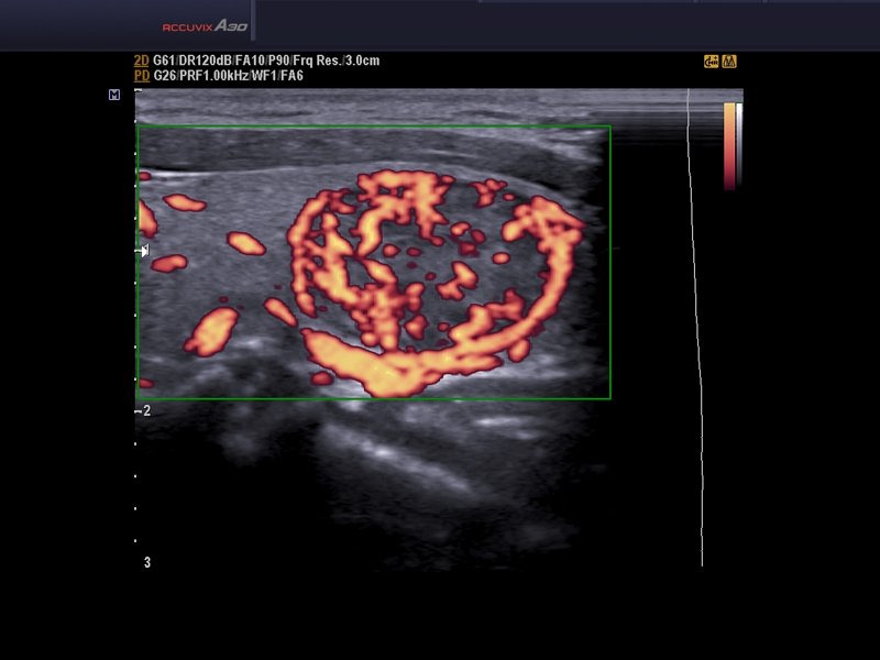 Thyroid - adenoma, power doppler (echogramm №581)