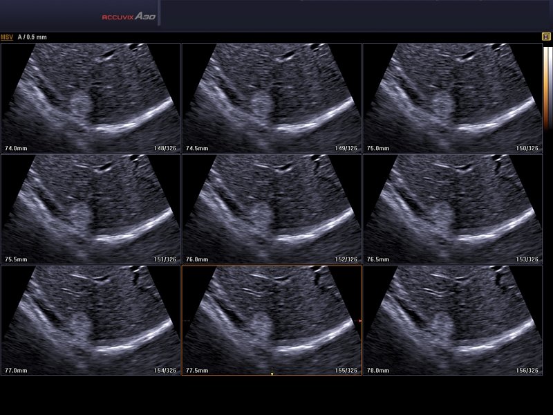 Liver - hemangioma, MSV (echogramm №582)