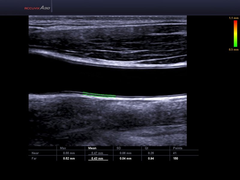 Common carotid artery, Auto IMT (echogramm №584)