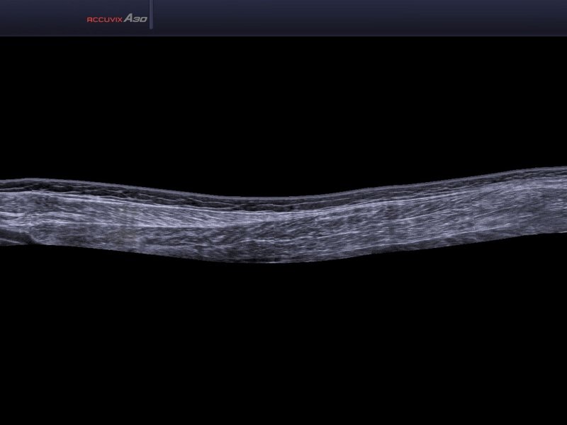 Gastrocnemius muscle, B-mode (echogramm №585)